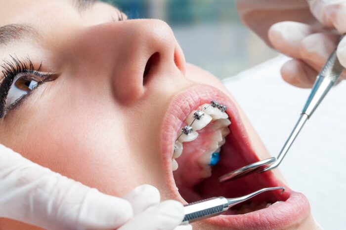 The Key Benefits Of Tooth-Coloured Fillings For Lasting Oral Health Waterloo Dental Centre